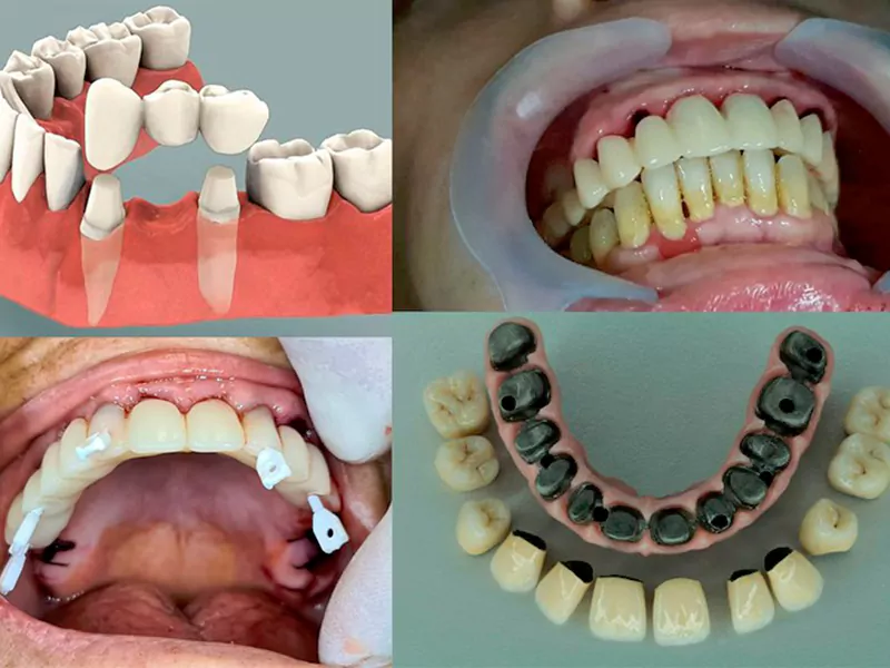 Dental_prosthesis