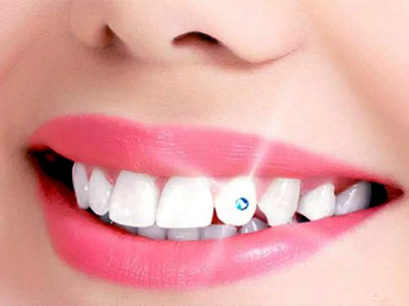 dental-jewelry