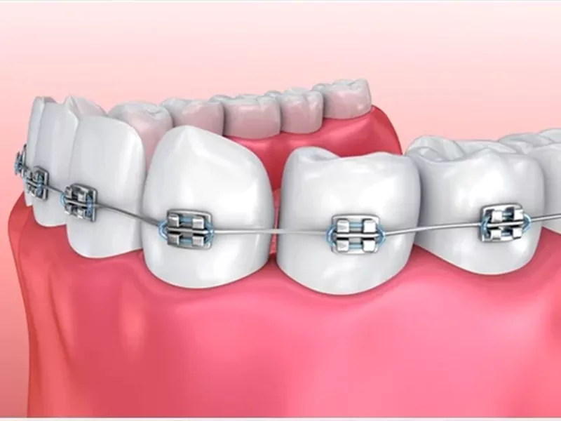 dental_brackets